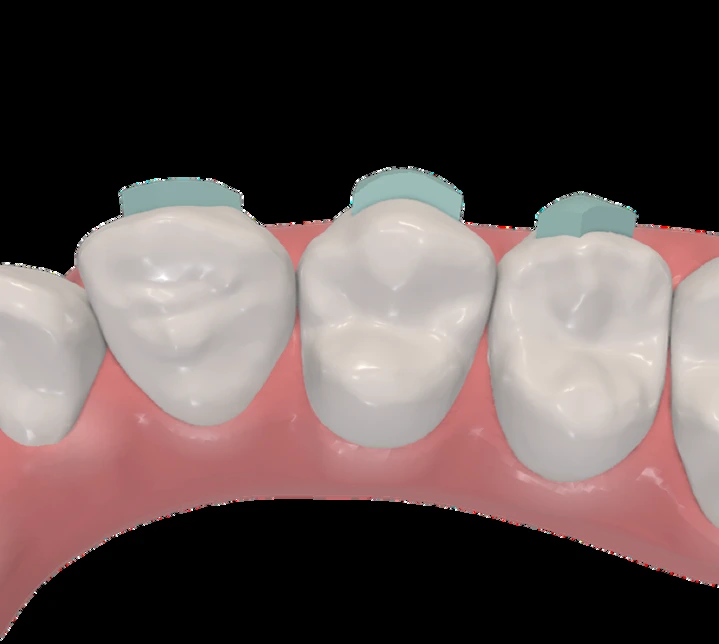 Macro del modello dentale con attachment Morpho color turchese dalla presentazione ufficiale