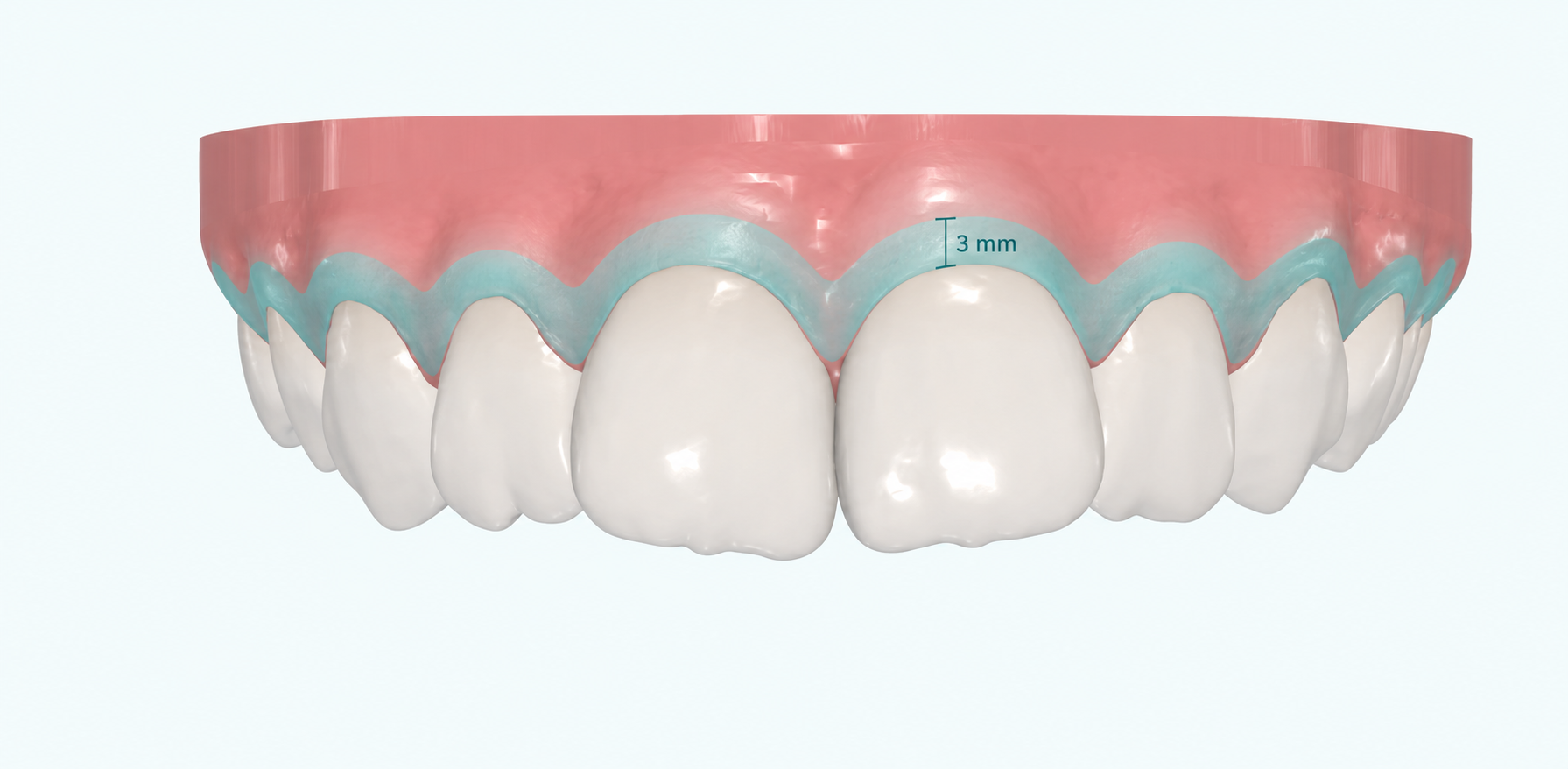 Modello Perio View su fondo chiaro con fascia turchese lungo il margine gengivale e indicazione dei primi 3 mm di gengiva reale