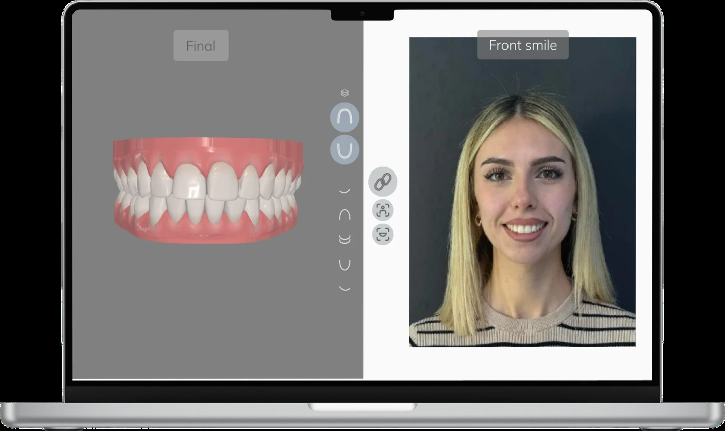 Anteprima Nuvola Restore: modello dentale digitale a sinistra e fotografia del sorriso a destra